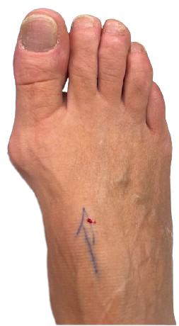 Bunion surgery before image