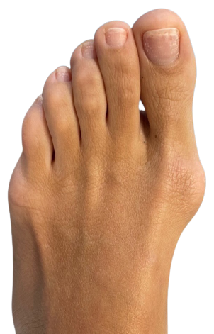 Before bunion surgery image