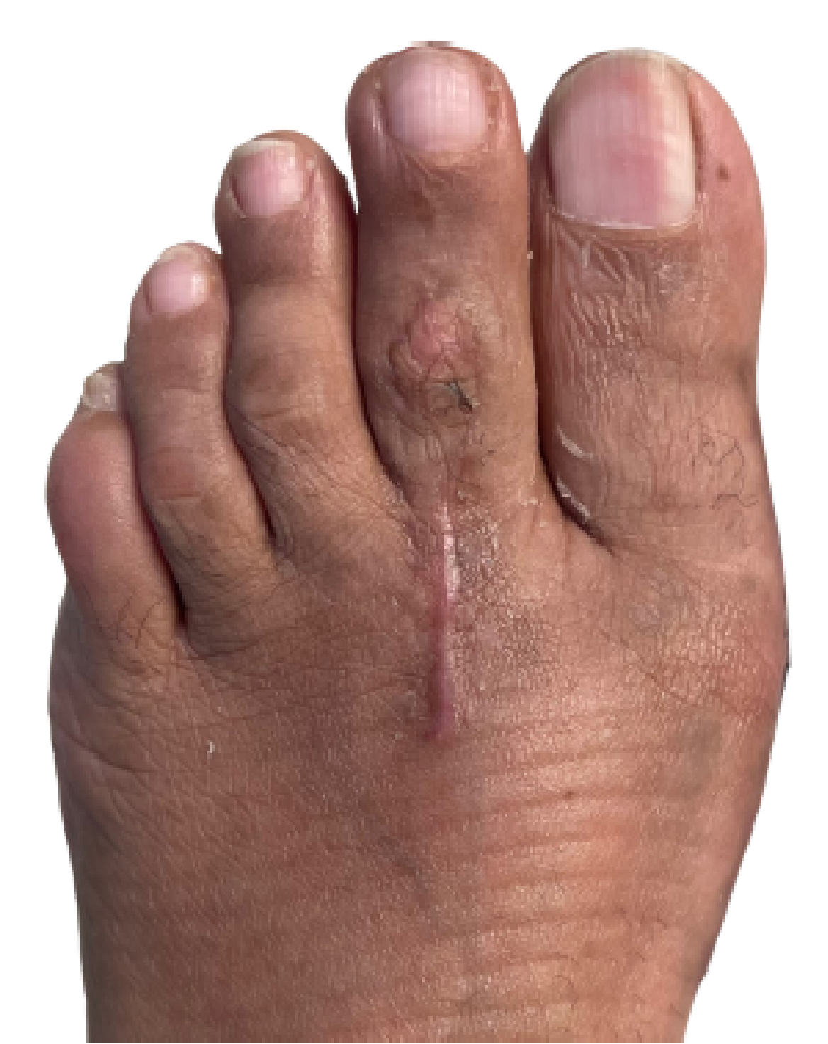 After Bunion and Toe Correction 