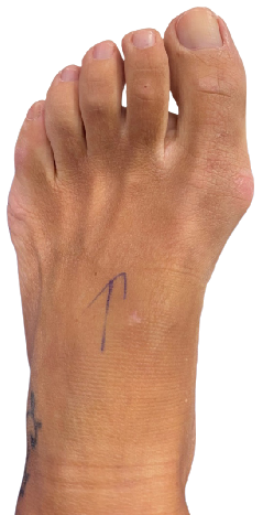 Bunion surgery before image