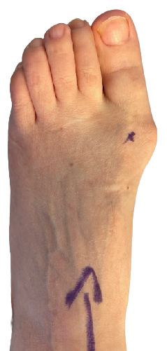 Before bunion surgery image