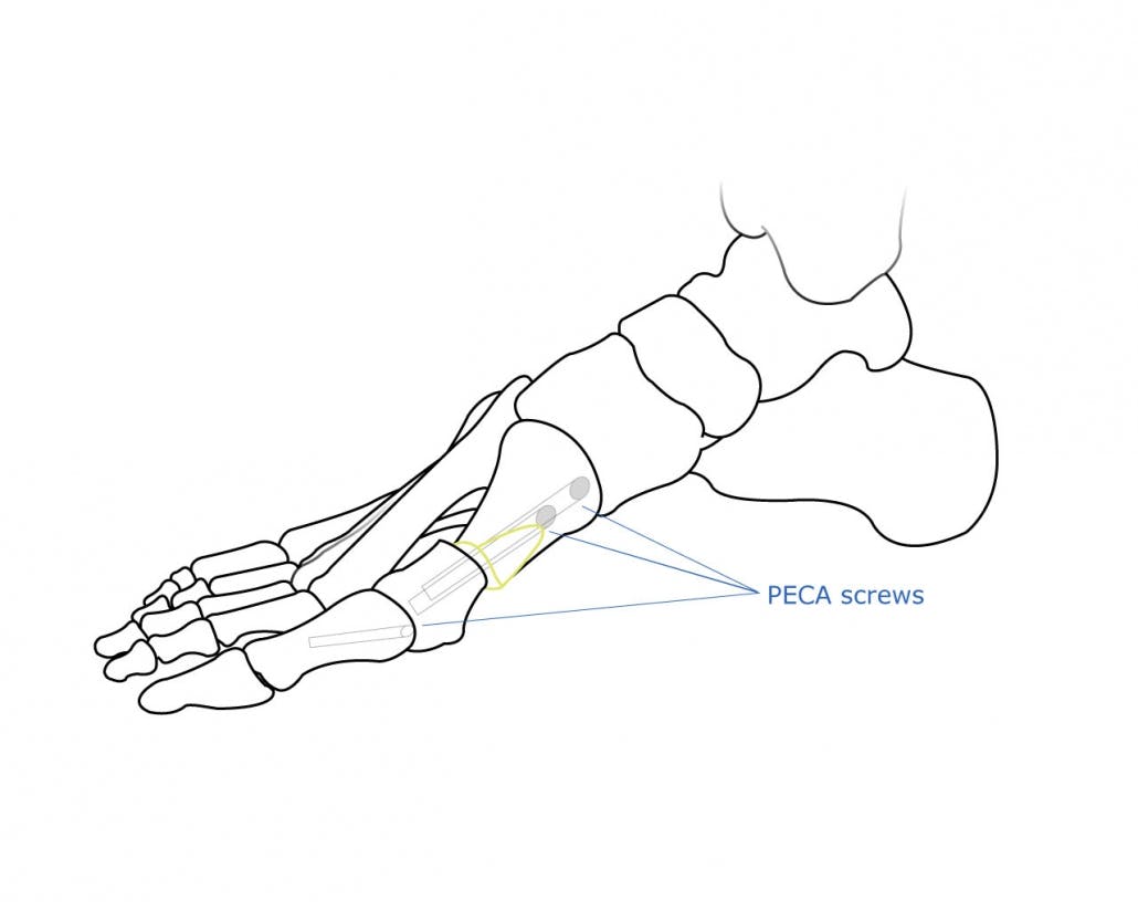Skeletal image with PECA screws, that are used during minimally invasive bunion surgery