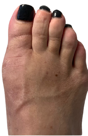After bunion surgery image