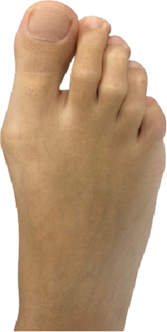 before surgery picture of bunion