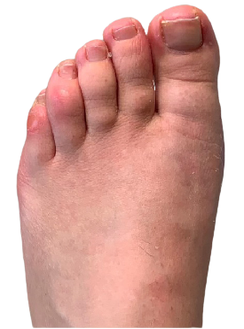 After bunion surgery image