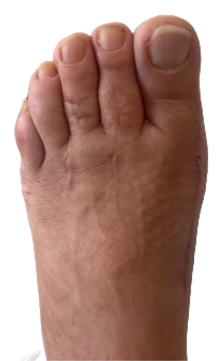 After Bunion and toe correction surgery