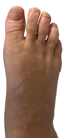 Bunion surgery after image