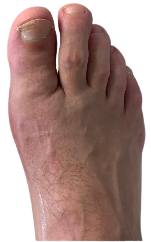 After bilateral bunion surgery image